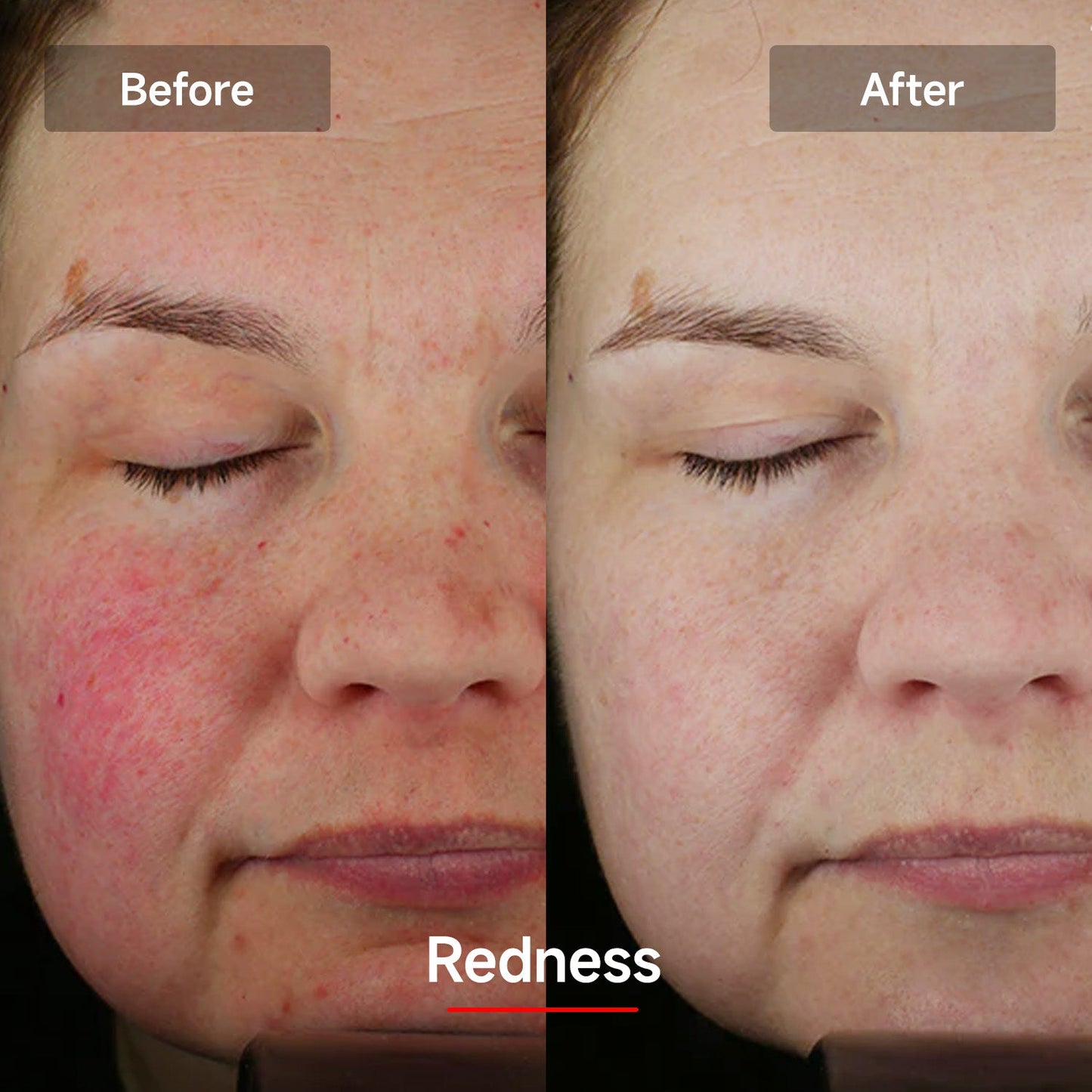 Megelin LASER&LED Light Therapy Mask
